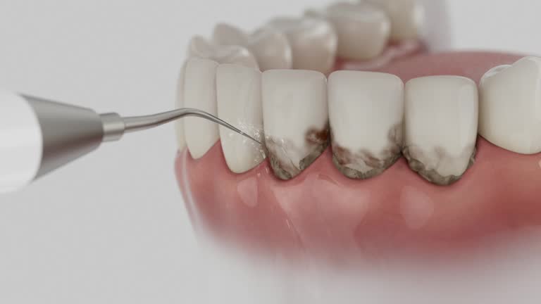 Trusted Teeth Whitening service in Breckenridge, TX - Dentist Open Now